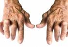 Romatizma Nedir? Romatizma Türleri, Belirtileri ve Bitkisel Tedavisi!