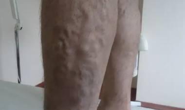 Varis Nedir? Bitkisel Tedavisi Nedir?