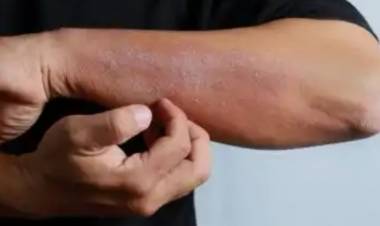 Cilt Mantarı Neden Olur? Nasıl Tedavi Edilir?