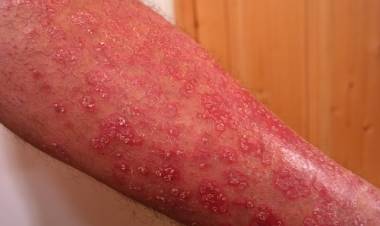 Sedef Nedir?  Sedef Belirtileri Nelerdir? Sedef Nasıl Geçer?