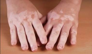 Vitiligo Nedir?  Vitiligo Belirtileri Nelerdir? Vitiligo Nasıl Geçer?