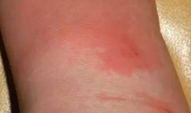 Yılancık ve Uçuk Nedir?  Yılancık ve Uçuk Doğal Tedavisi Nasıldır?