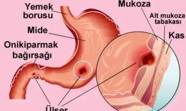 Mide Ülserinin Doğal Tedavisi