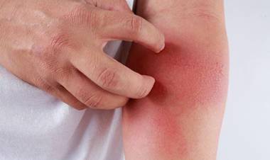 Egzama Nedir?  Egzama Belirtileri Nelerdir? Egzama Nasıl Geçer?