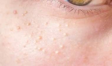 Yağ Bezesi ve Burun Eti İçin Doğal İlaçlar!