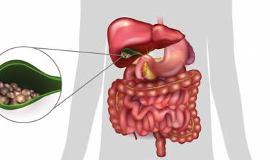 Safra Taşı Neden Olur? Safra Taşı Belirtileri Nelerdir? Safra Taşının Bitkisel Tedavisi Nedir?