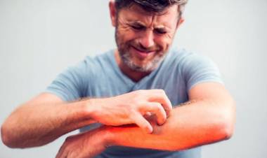 Uyuza Ne İyi Gelir? Evde Bitkisel Çözümü Nedir?