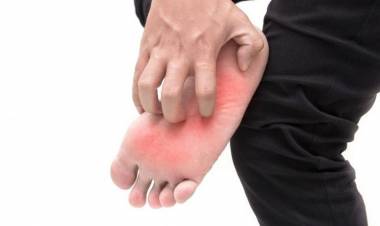 Ayak Altı Yanması Neden Olur? Ayak Altı Yanmasının Bitkisel ve Doğal Tedavisi Nasıl Yapılır?