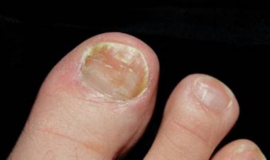 Tırnak Mantarı Bitkisel Tedavisi Nasıl Yapılır? Tırnak Mantarına Ne İyi Gelir?