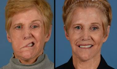 Yüz Felci Neden Olur? Belirtileri Nelerdir? Yüz Felci Bitkisel Tedavisi?