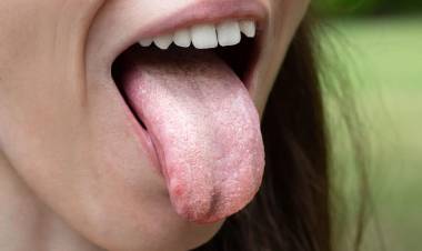 Bağırsakta Candida Mantarı Belirtileri Nelerdir? Bağırsakta Candida Mantarı Bitkisel Tedavisi Nedir?