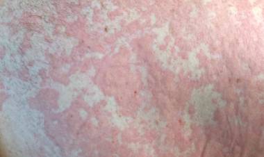 Ürtiker ( Kurdeşen) Nedir? Ürtiker (Kurdeşen)’in Bitkisel Tedavisi Nedir?