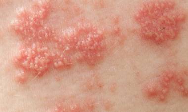 Zona Hastalığı Belirtileri Nelerdir? Zona Hastalığına Ne İyi Gelir?