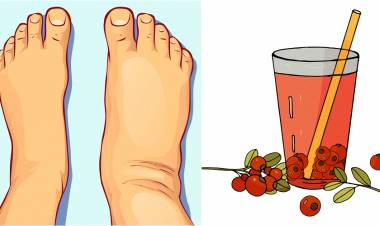 Ödem Nedir? Ödemin Bitkisel ve Doğal Tedavisi Nasıl Yapılır?