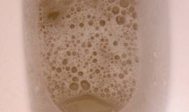 Köpüklü İdrar Nedir? İdrarın Köpürmesi Nedenleri ve Tedavisi!