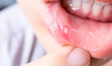 Ağız Yarasına Ne İyi Gelir?