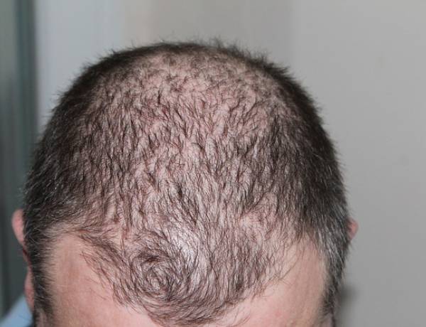 Saç Dökülmesi ve Doğal Tedavisi