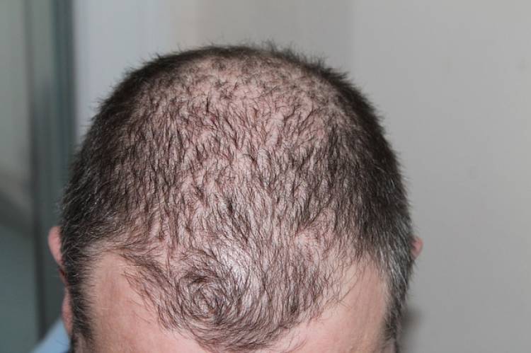 Saç Dökülmesi ve Doğal Tedavisi