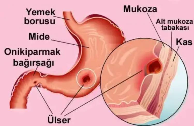 Mide Ülserinin Doğal Tedavisi